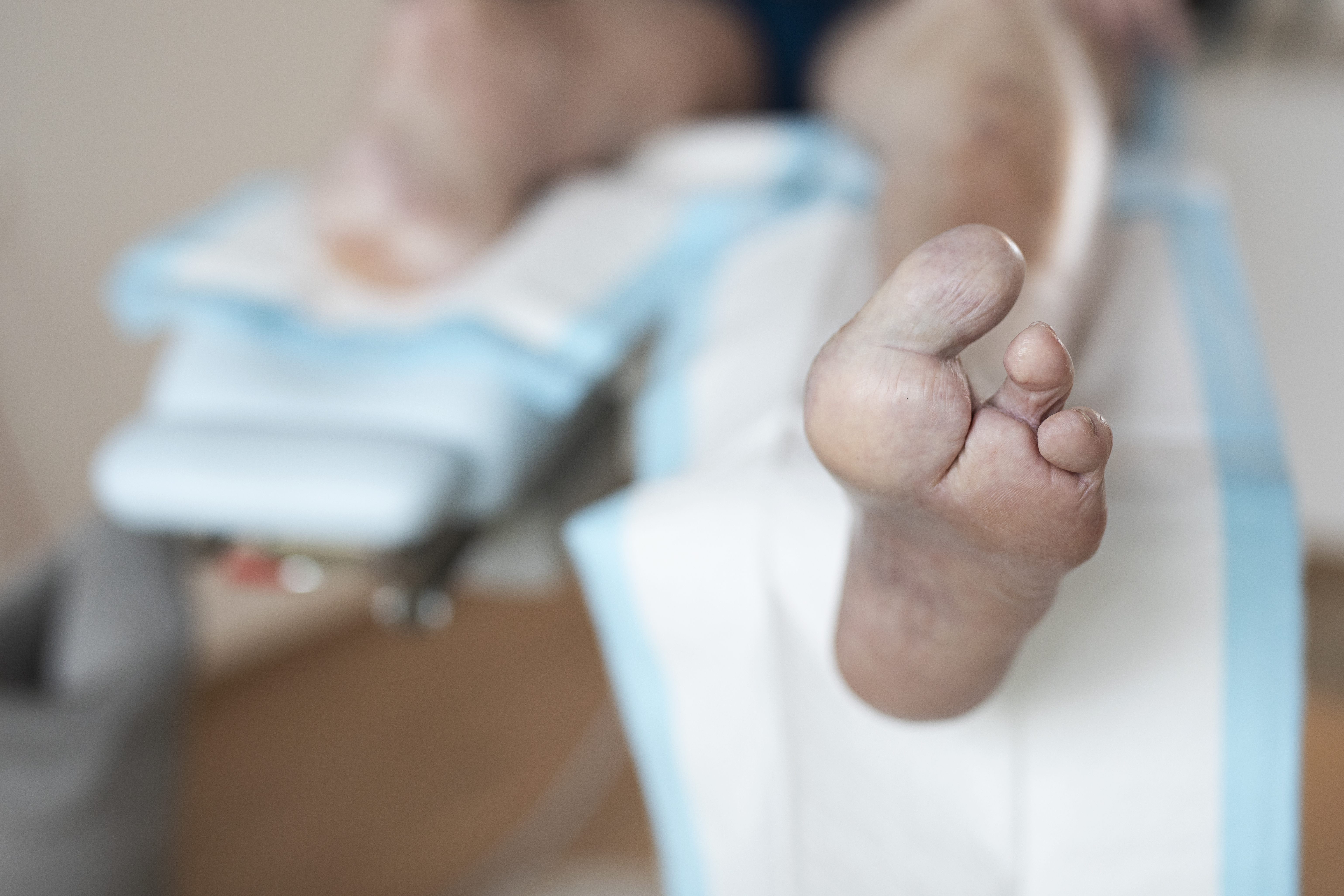 Billede af en fod med amputerede tæer