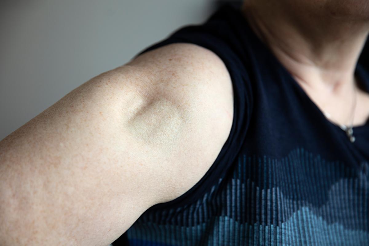 Et billede af lipoatrofi på en overarm.