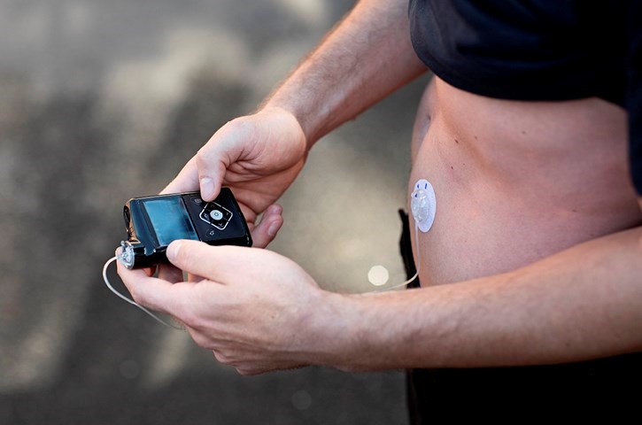 Billede af en moderne insulinpumpe