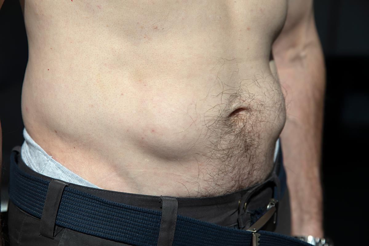 Billede af to tydelige infiltrater på maven efter injektion af insulin.