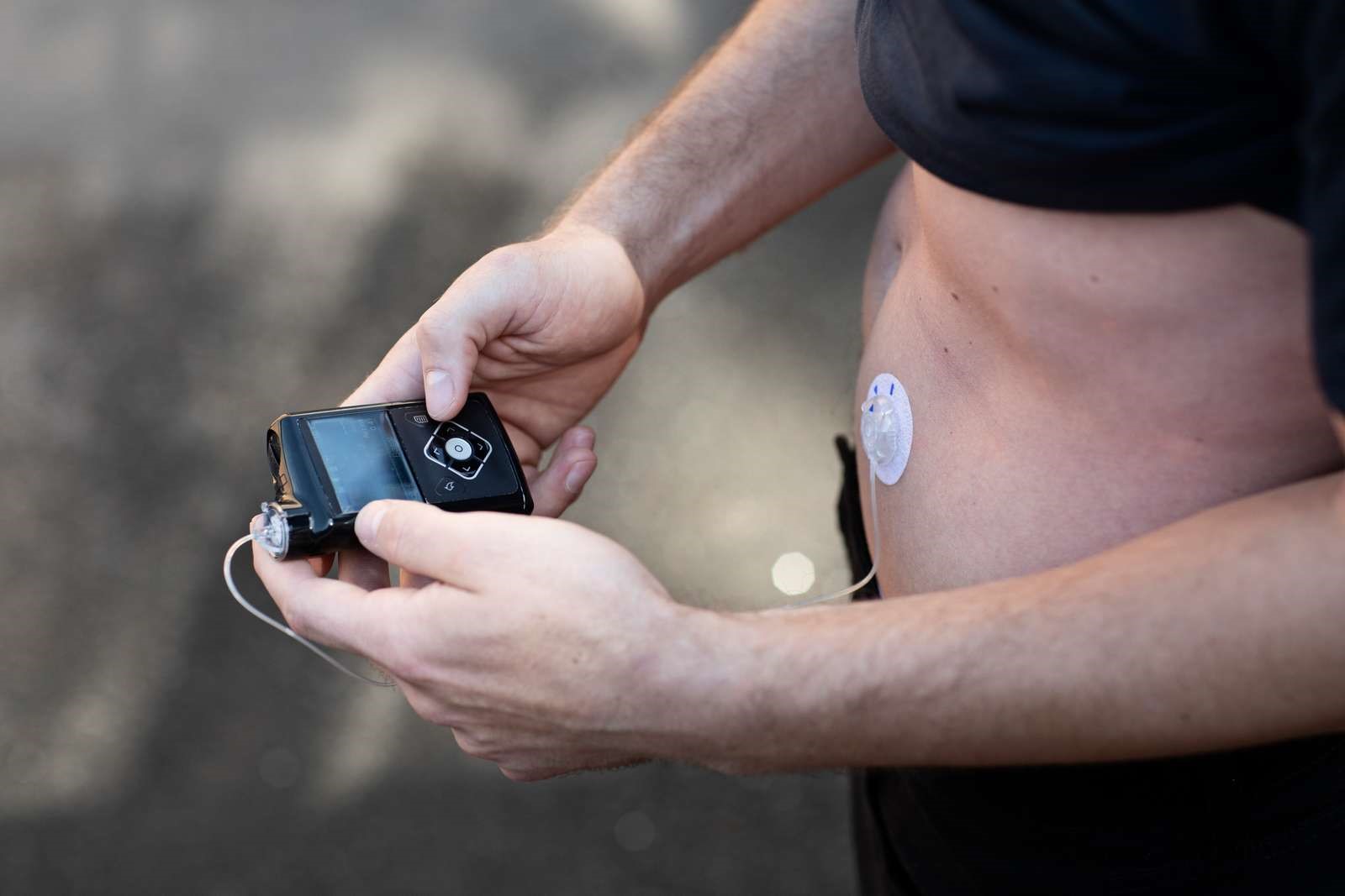 Billede af en insulinpumpe, der er sat på maven af en person.